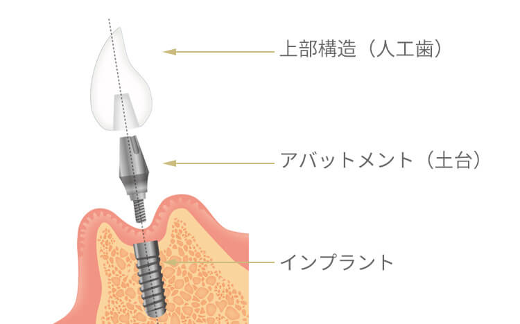 インプラントの構造図。上部構造(人工歯)、アバットメント(土台)、インプラント