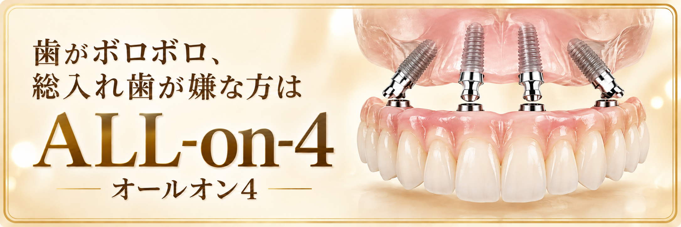 歯がボロボロ、総入れ歯が嫌な方は ALL-on-4 オールオン4