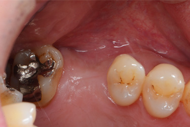 少数歯欠損治療前