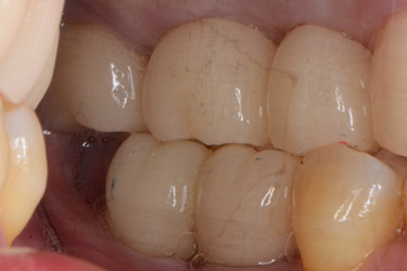 奥歯の複数歯欠損治療後
