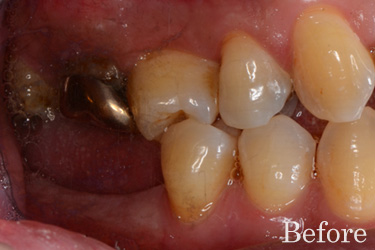 奥歯の複数歯欠損治療前