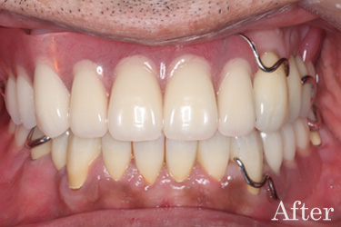 前歯の複数歯欠損治療後