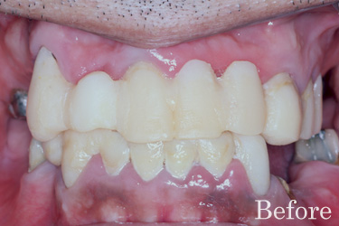 前歯の複数歯欠損治療前