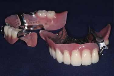 複数歯欠損治療前