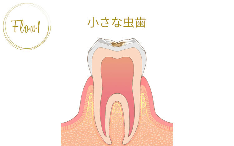 虫歯の第一段階「小さい虫歯」