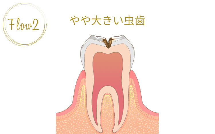 虫歯の第二段階「やや大きい虫歯」