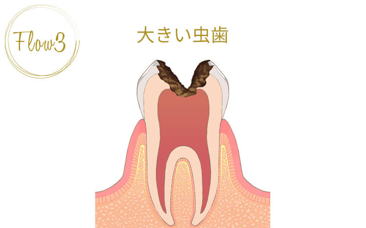 虫歯の第三段階「大きい虫歯」