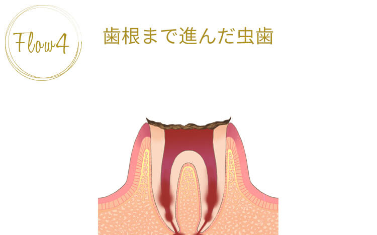 虫歯の第四段階「歯根まで進んだ虫歯」