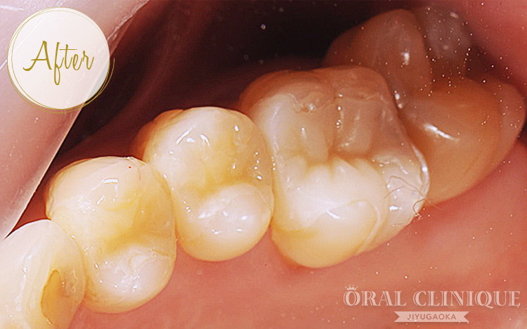 オールセラミックインレー治療後