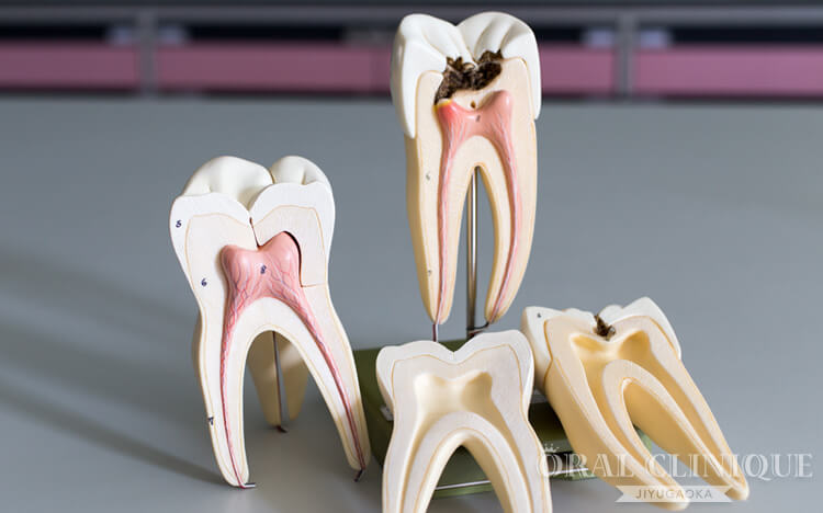 虫歯の再発リスクが低いセラミックの歯