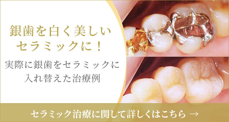銀歯を白く美しいセラミックに!実際に銀歯をセラミックに入れ替えた治療例、セラミック治療に関して詳しくはこちら
