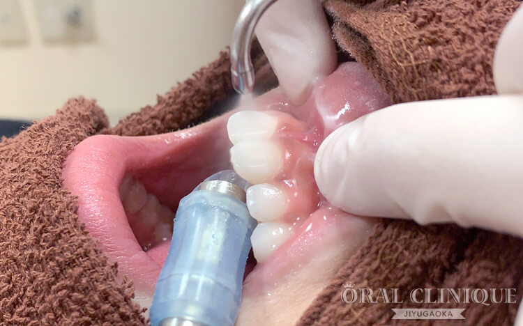クリーニングの流れ2:歯垢・着色の除去