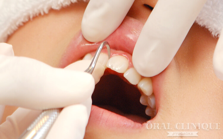 クリーニングの流れ4:細かい歯石の除去