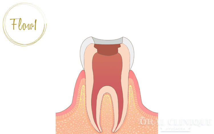 虫歯が神経達した状態