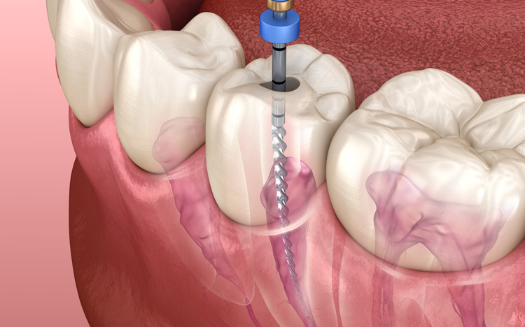 根管治療