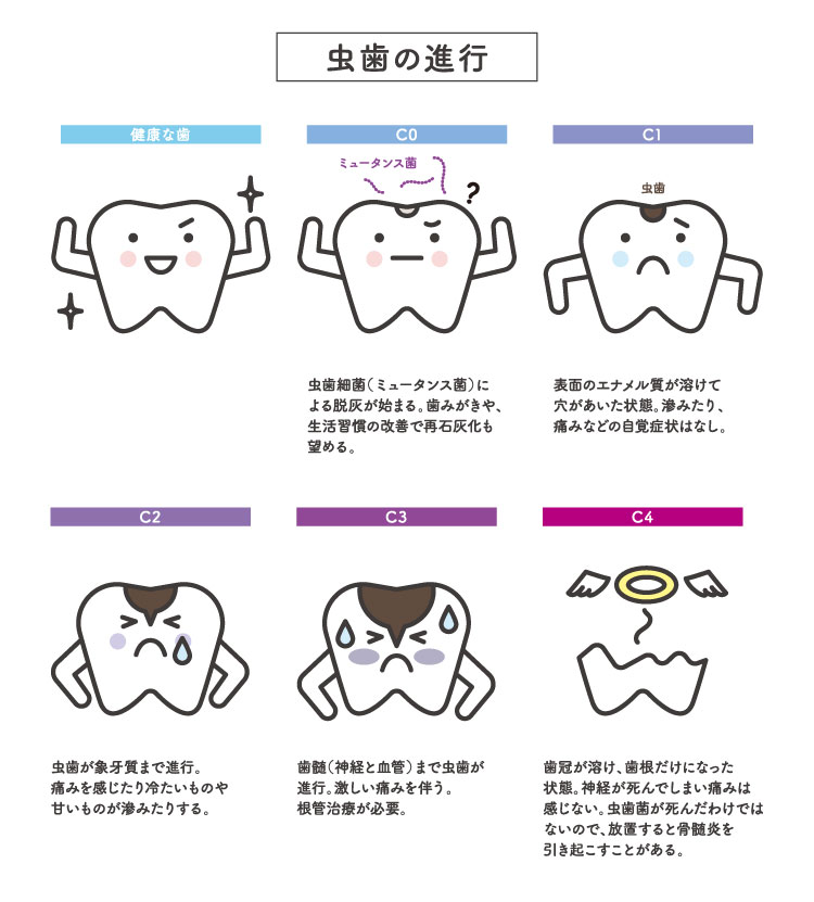 虫歯の進行