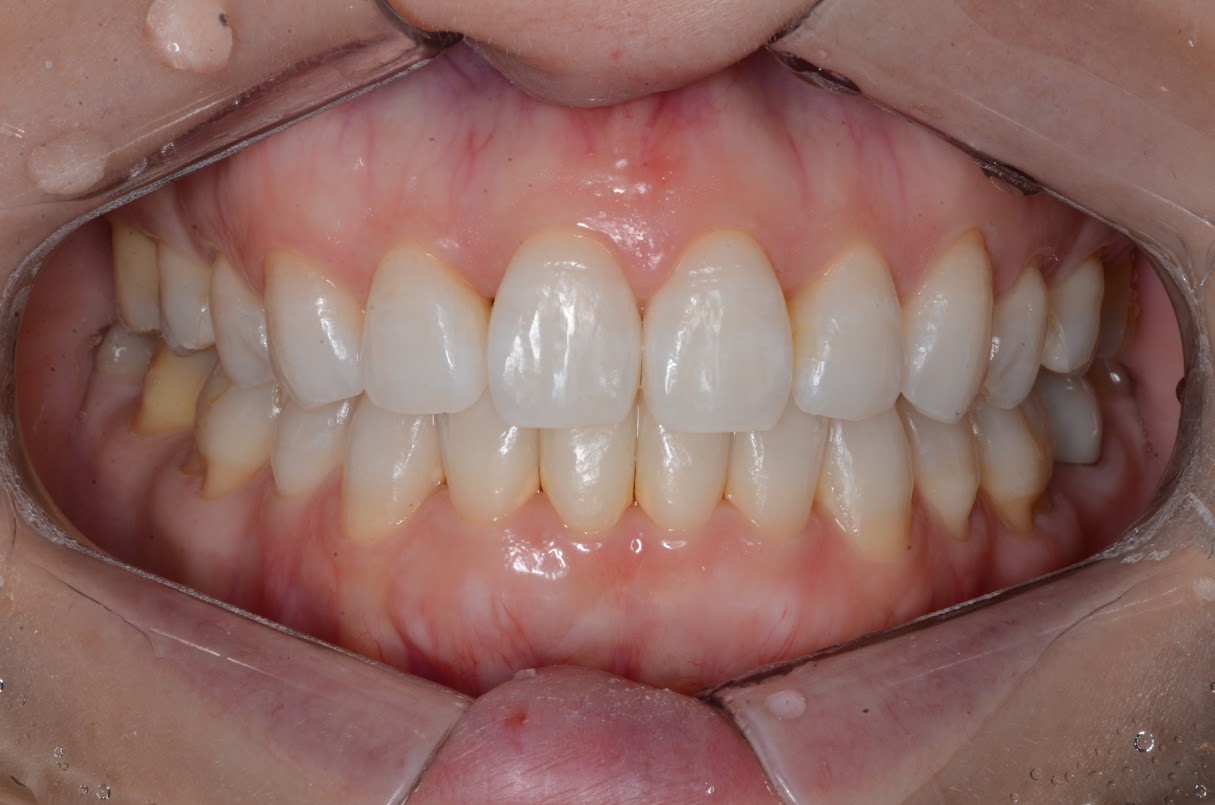 すきっ歯の歯列矯正術後