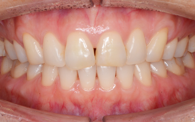 前歯のインビザライン：治療後