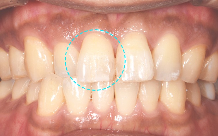 ウォーキングブリーチで前歯の変色を処置した状態