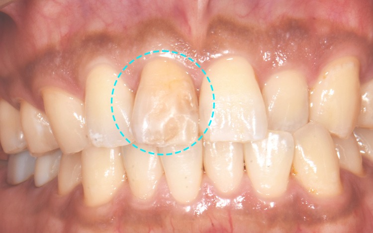 前歯が変色した状態