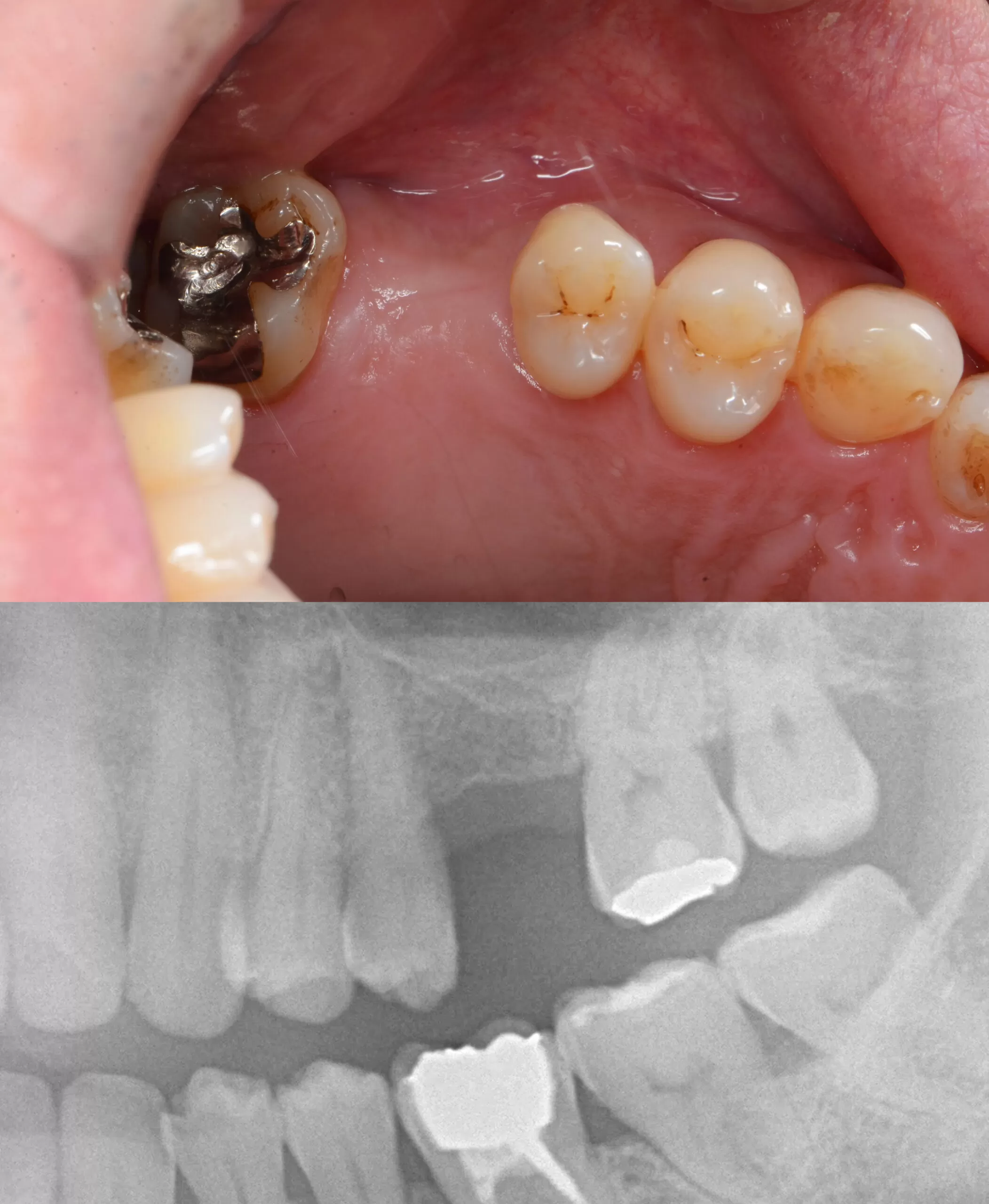 多数歯欠損無歯顎欠損のインプラント治療 欠損後放置していた奥歯のインプラント治療例｜東京・自由が丘の歯医者
